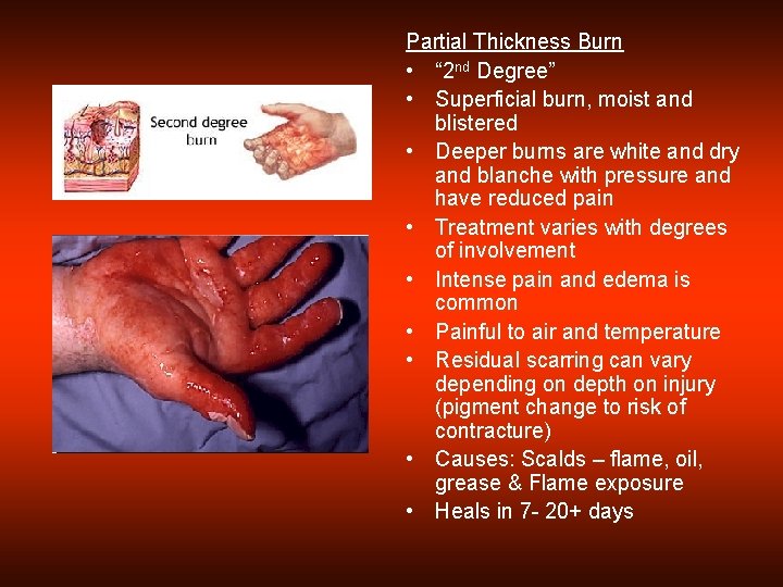 Partial Thickness Burn • “ 2 nd Degree” • Superficial burn, moist and blistered
