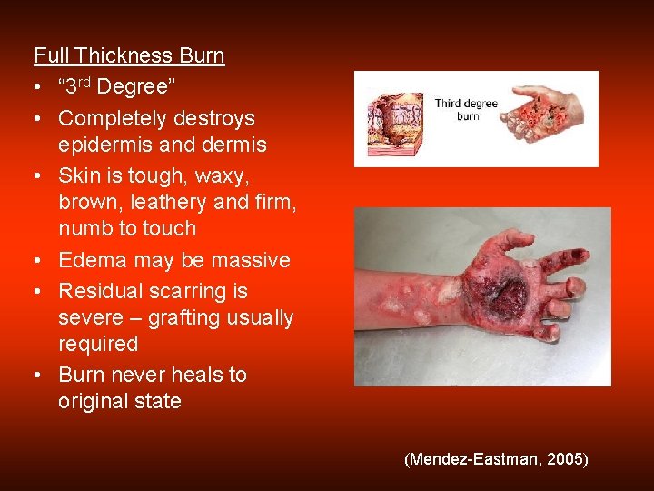 Full Thickness Burn • “ 3 rd Degree” • Completely destroys epidermis and dermis