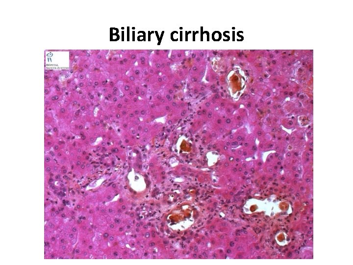Biliary cirrhosis Biliary cirrhosis