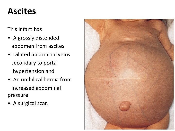 Ascites This infant has • A grossly distended abdomen from ascites • Dilated abdominal Ascites This infant has • A grossly distended abdomen from ascites • Dilated abdominal