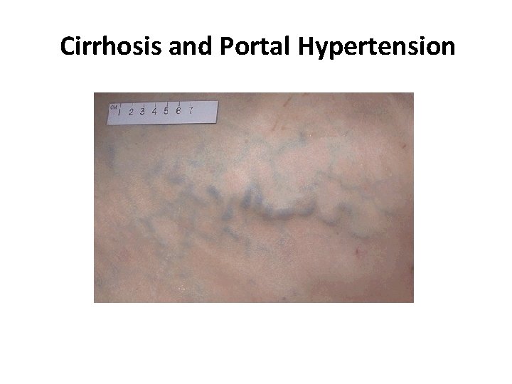 Cirrhosis and Portal Hypertension Cirrhosis and Portal Hypertension