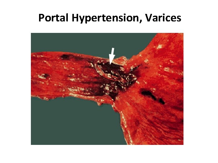 Portal Hypertension, Varices Portal Hypertension, Varices