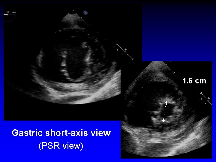 1. 6 cm +. . . + Gastric short-axis view (PSR view) 