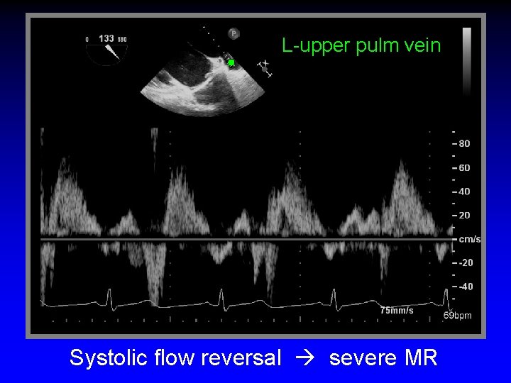 L-upper pulm vein Systolic flow reversal severe MR 