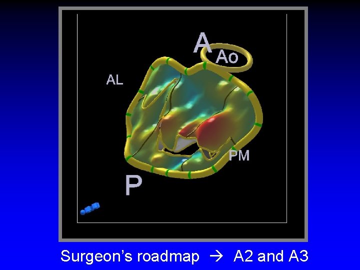 Surgeon’s roadmap A 2 and A 3 