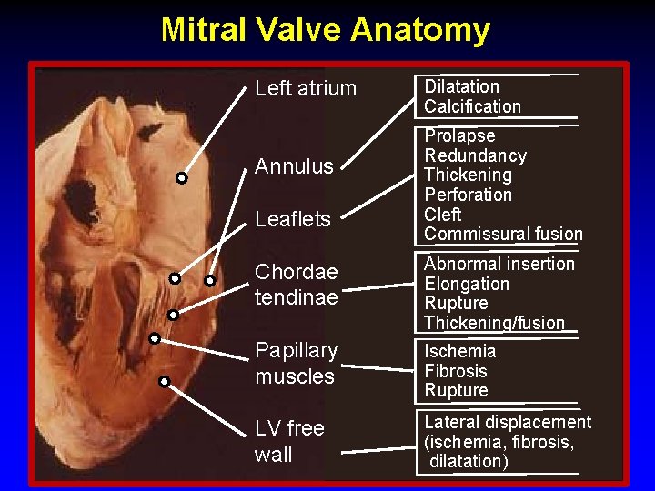 Mitral Valve Anatomy Dilatation Left atrium Annulus Leaflets Dilatation Calcification Prolapse Redundancy Thickening Perforation