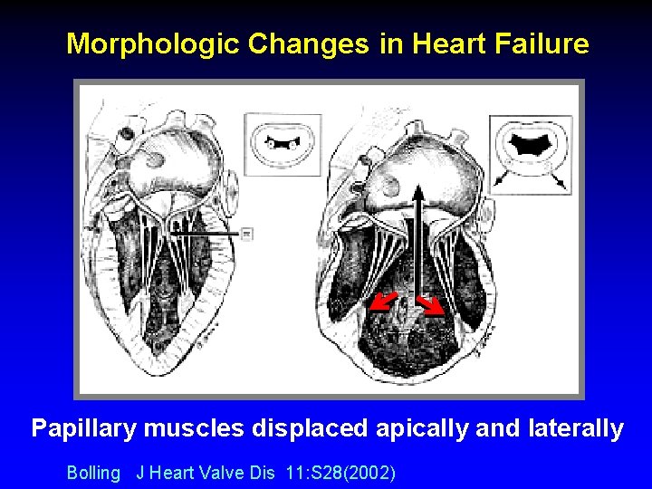 Morphologic Changes in Heart Failure Papillary muscles displaced apically and laterally Bolling J Heart