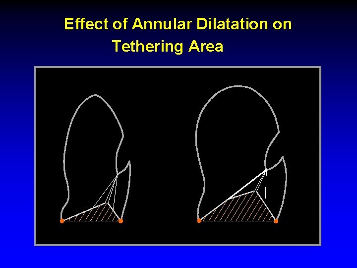 Effect of Annular Dilatation on Tethering Area MROP 340 