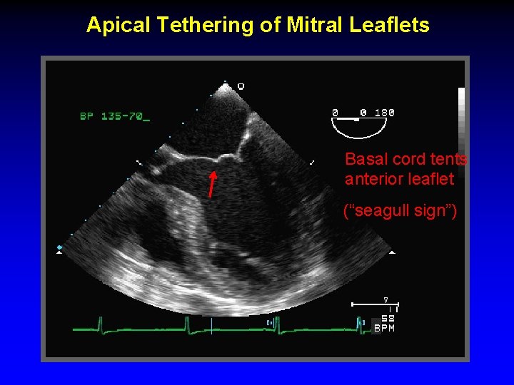 Apical Tethering of Mitral Leaflets Basal cord tents anterior leaflet (“seagull sign”) 