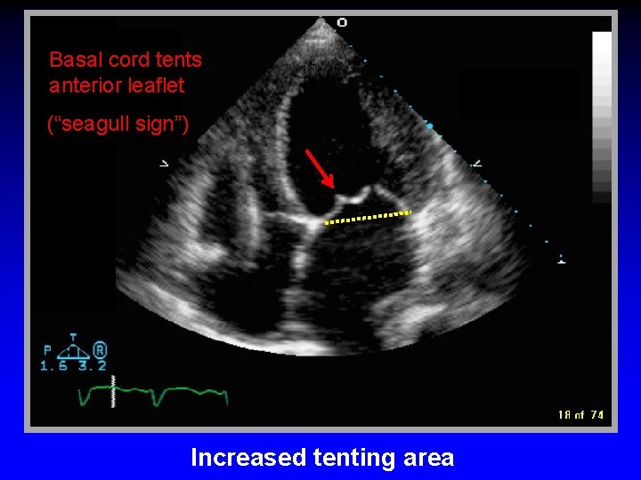 Basal cord tents anterior leaflet (“seagull sign”) Increased tenting area 