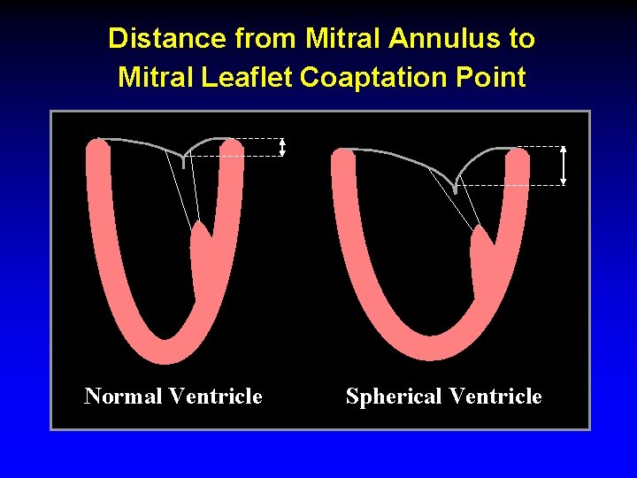 Distance from Mitral Annulus to Mitral Leaflet Coaptation Point Normal Ventricle Spherical Ventricle 
