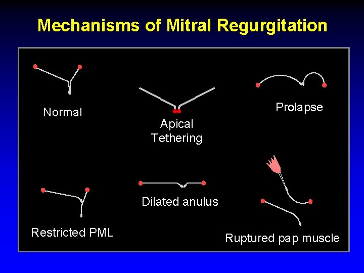 Mechanisms of Mitral Regurgitation Normal Prolapse Apical Tethering Dilated anulus Restricted PML Ruptured pap