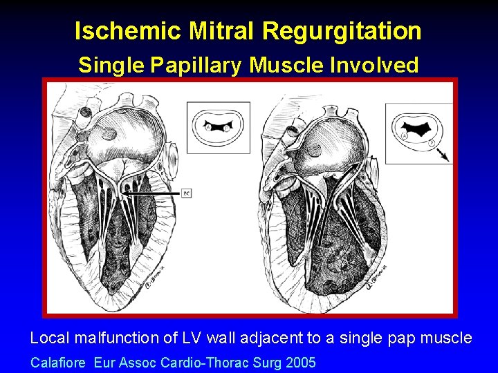 Ischemic Mitral Regurgitation Single Papillary Muscle Involved Local malfunction of LV wall adjacent to