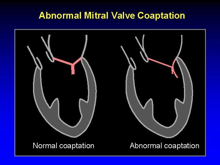 Abnormal Mitral Valve Coaptation Normal coaptation Abnormal coaptation 