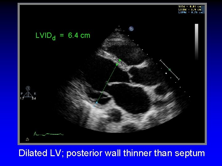 LVIDd = 6. 4 cm Dilated LV; posterior wall thinner than septum 