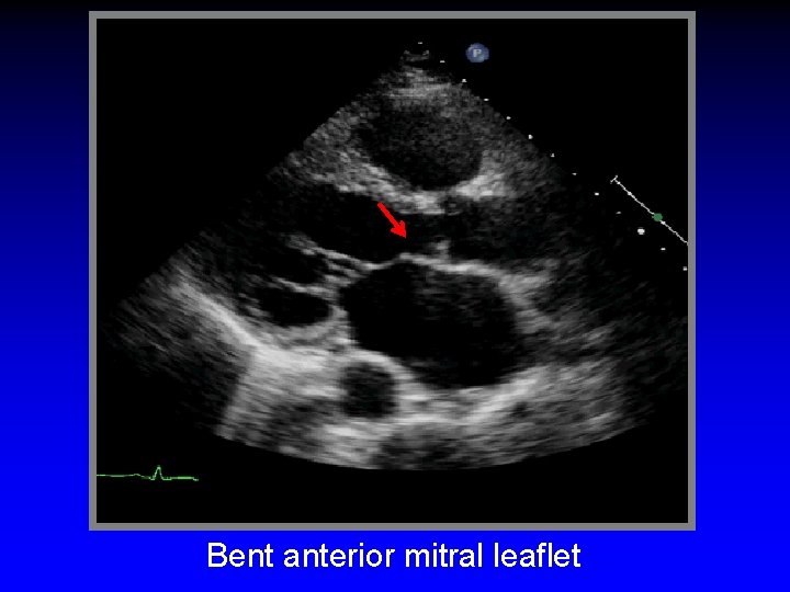 Bent anterior mitral leaflet 