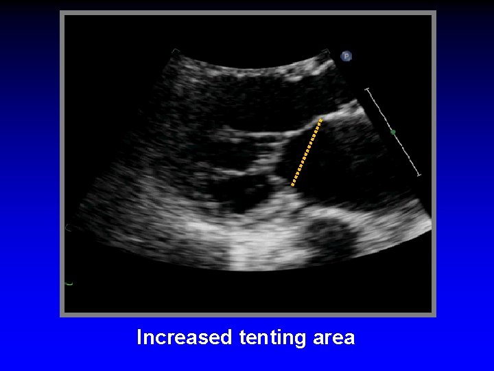 Increased tenting area 