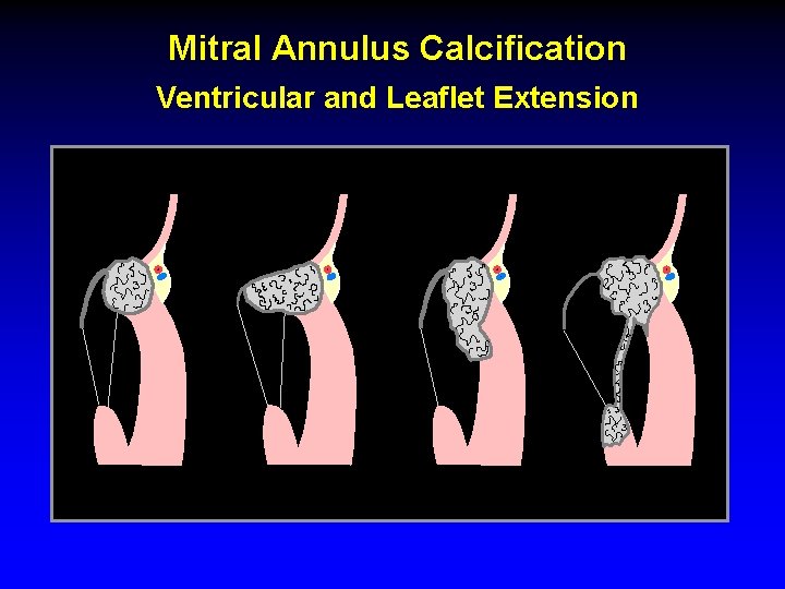 Mitral Annulus Calcification Ventricular and Leaflet Extension 