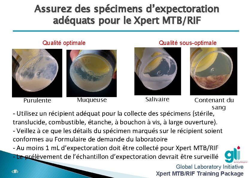 Assurez des spécimens d’expectoration adéquats pour le Xpert MTB/RIF Qualité optimale Purulente Muqueuse Qualité