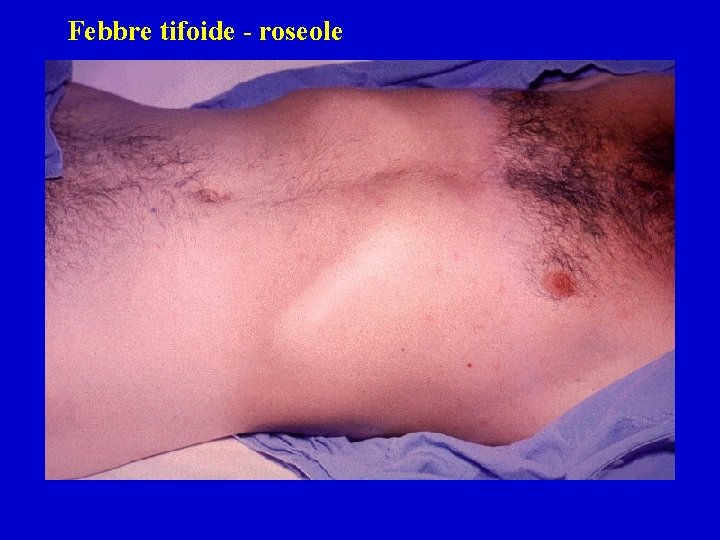 Febbre tifoide - roseole 