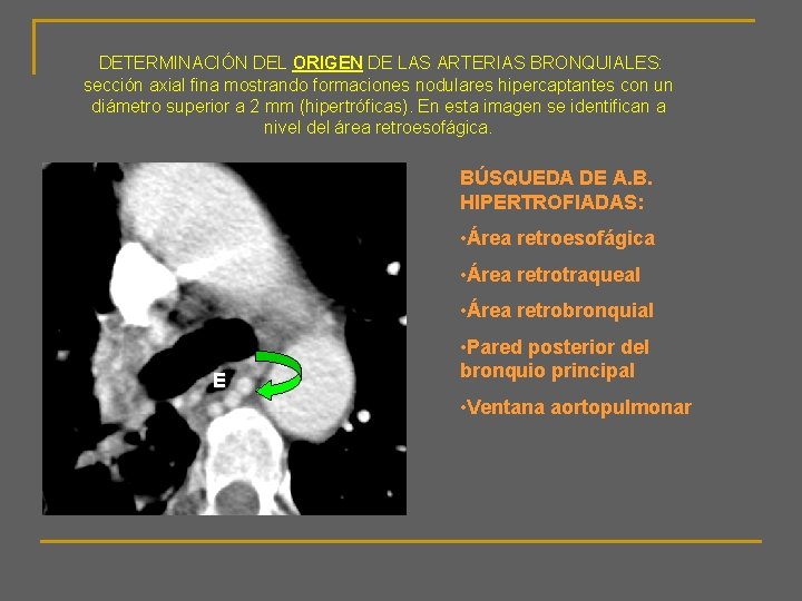 DETERMINACIÓN DEL ORIGEN DE LAS ARTERIAS BRONQUIALES: sección axial fina mostrando formaciones nodulares hipercaptantes