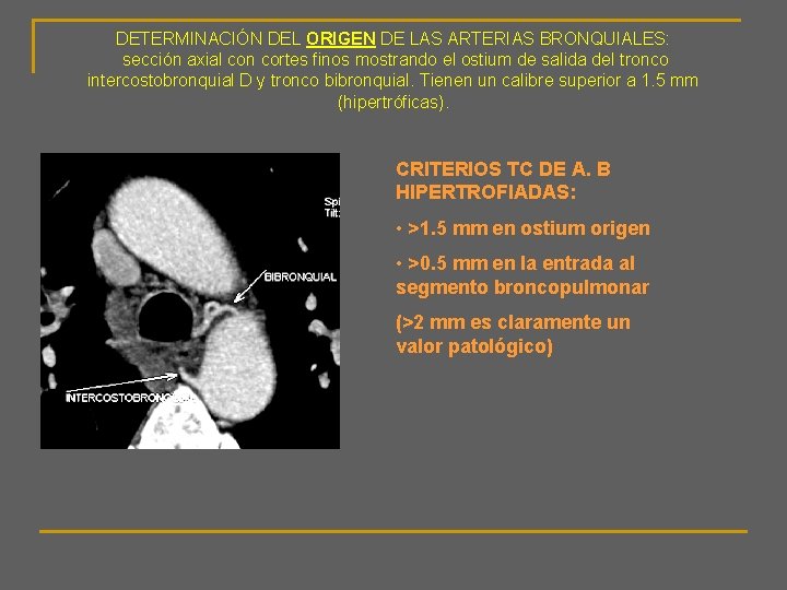 DETERMINACIÓN DEL ORIGEN DE LAS ARTERIAS BRONQUIALES: sección axial con cortes finos mostrando el