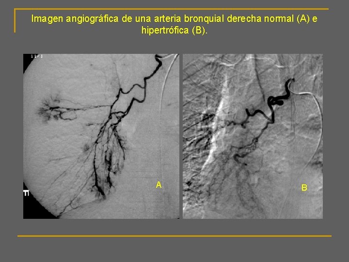 Imagen angiográfica de una arteria bronquial derecha normal (A) e hipertrófica (B). A B