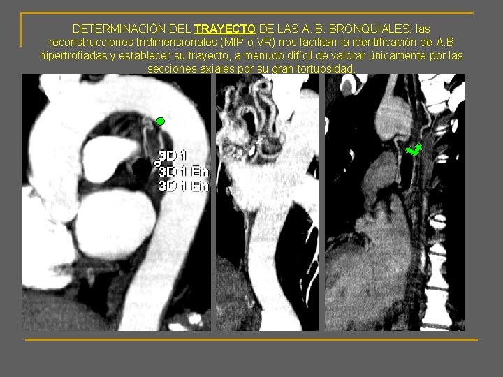 DETERMINACIÓN DEL TRAYECTO DE LAS A. B. BRONQUIALES: las reconstrucciones tridimensionales (MIP o VR)