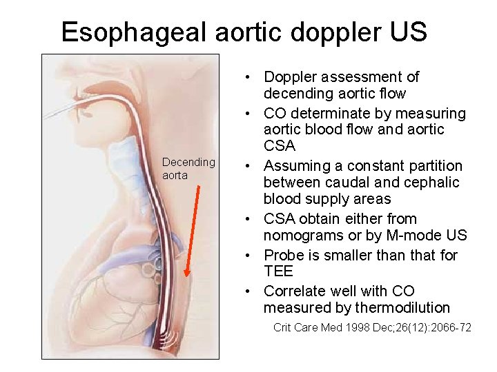 Esophageal aortic doppler US Decending aorta • Doppler assessment of decending aortic flow •