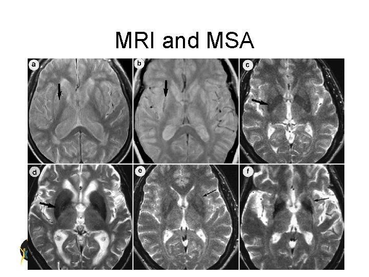 MRI and MSA 