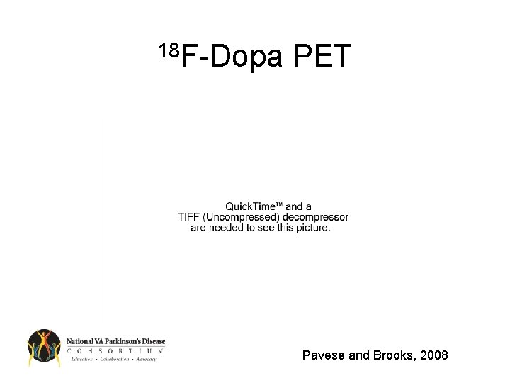 18 F-Dopa PET Pavese and Brooks, 2008 