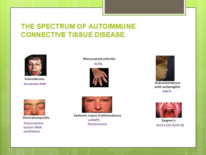 THE SPECTRUM OF AUTOIMMUNE CONNECTIVE TISSUE DISEASE 