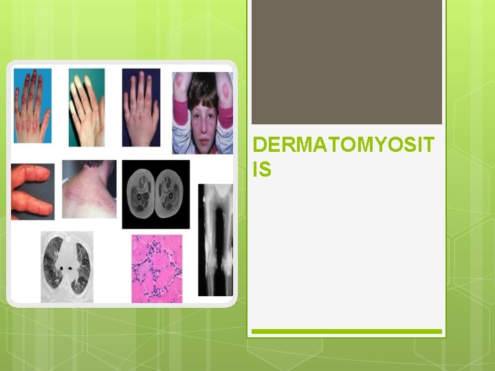 DERMATOMYOSIT IS 