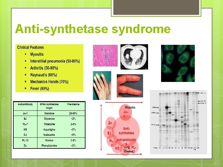 Anti-synthetase syndrome 
