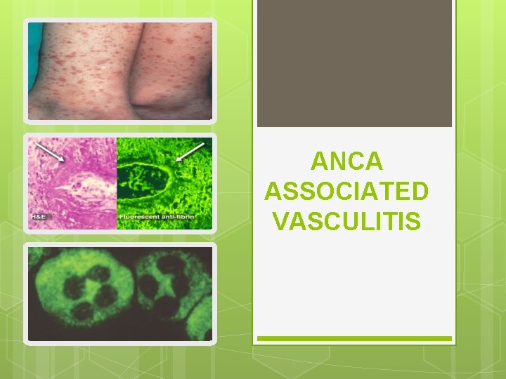 ANCA ASSOCIATED VASCULITIS 