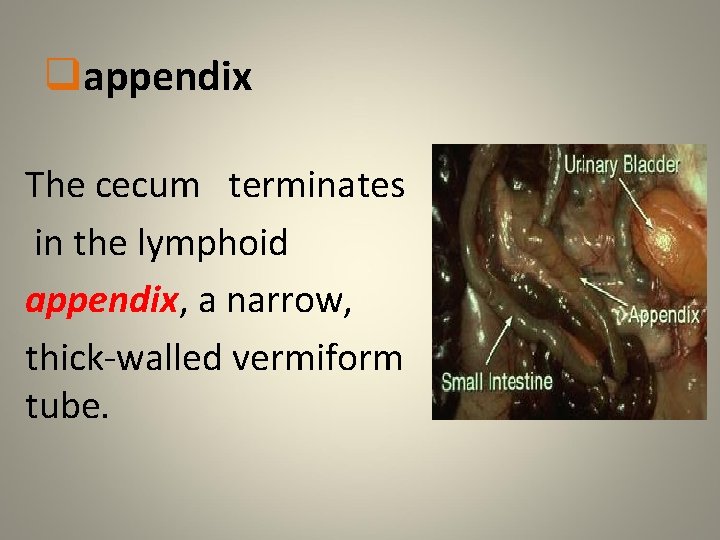 qappendix The cecum terminates in the lymphoid appendix, a narrow, thick-walled vermiform tube. 