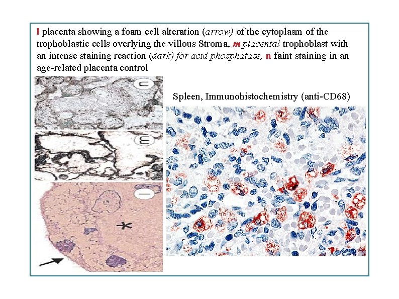 l placenta showing a foam cell alteration (arrow) of the cytoplasm of the trophoblastic