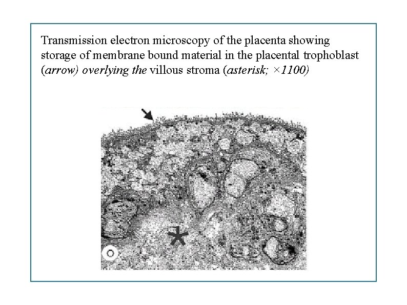 Transmission electron microscopy of the placenta showing storage of membrane bound material in the