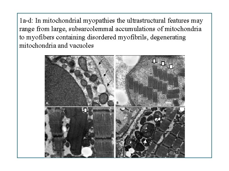 1 a-d: In mitochondrial myopathies the ultrastructural features may range from large, subsarcolemmal accumulations