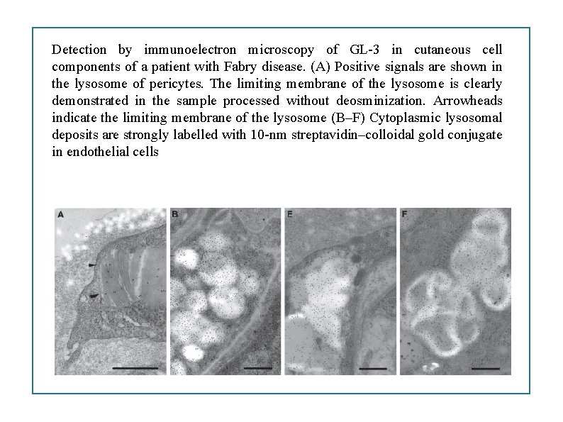 Detection by immunoelectron microscopy of GL-3 in cutaneous cell components of a patient with