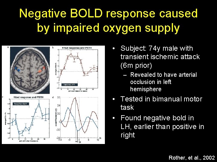 Negative BOLD response caused by impaired oxygen supply • Subject: 74 y male with