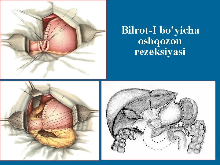 Bilrot-I bo’yicha oshqozon rezeksiyasi 18 