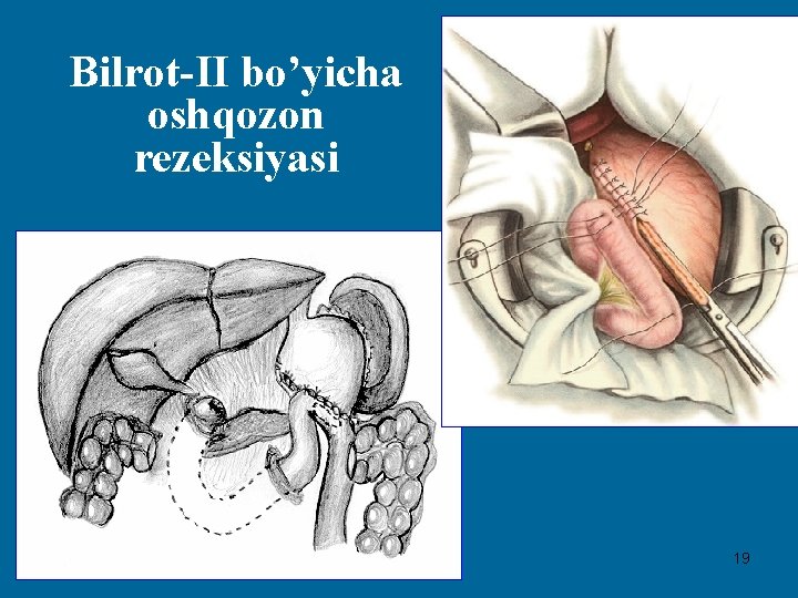 Bilrot-II bo’yicha oshqozon rezeksiyasi 19 