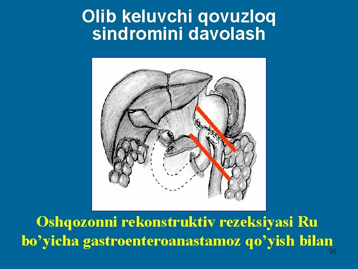 Olib keluvchi qovuzloq sindromini davolash Oshqozonni rekonstruktiv rezeksiyasi Ru bo’yicha gastroenteroanastamoz qo’yish bilan 36