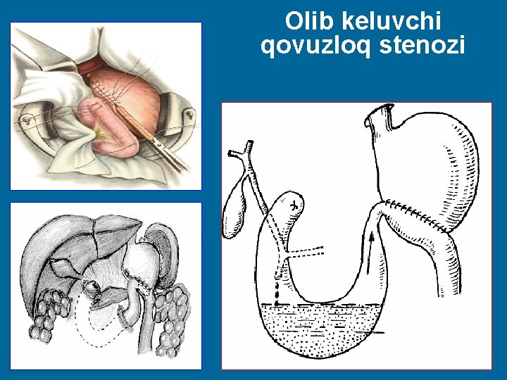 Olib keluvchi qovuzloq stenozi 37 