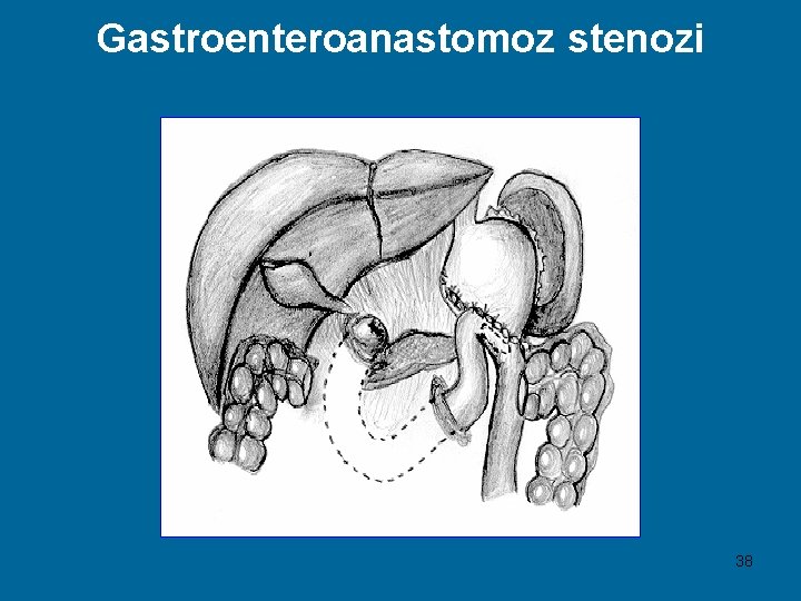 Gastroenteroanastomoz stenozi 38 