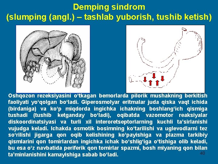 Demping sindrom (slumping (angl. ) – tashlab yuborish, tushib ketish) Oshqozon rezeksiyasini o‘tkagan bemorlarda