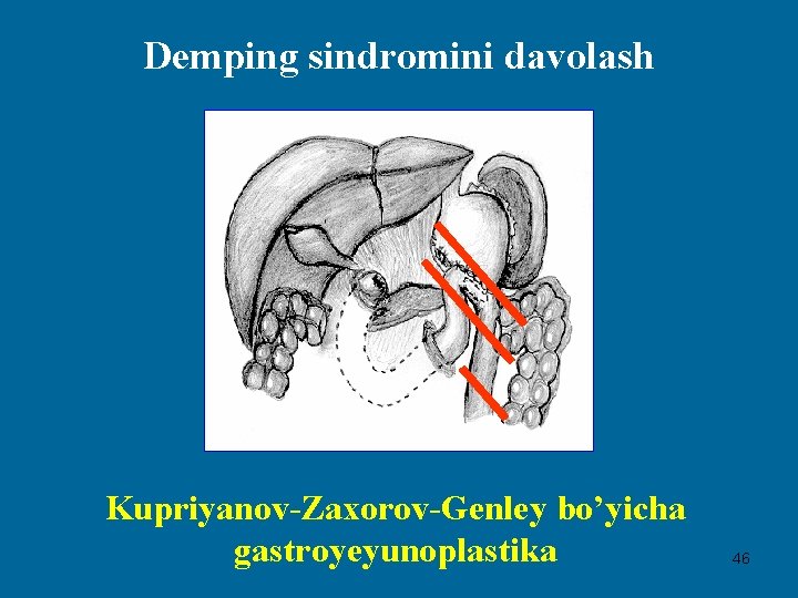 Demping sindromini davolash Kupriyanov-Zaxorov-Genley bo’yicha gastroyeyunoplastika 46 