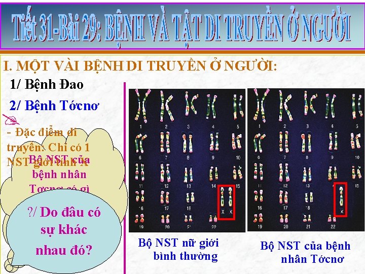 I. MỘT VÀI BỆNH DI TRUYỀN Ở NGƯỜI: 1/ Bệnh Đao 2/ Bệnh Tớcnơ