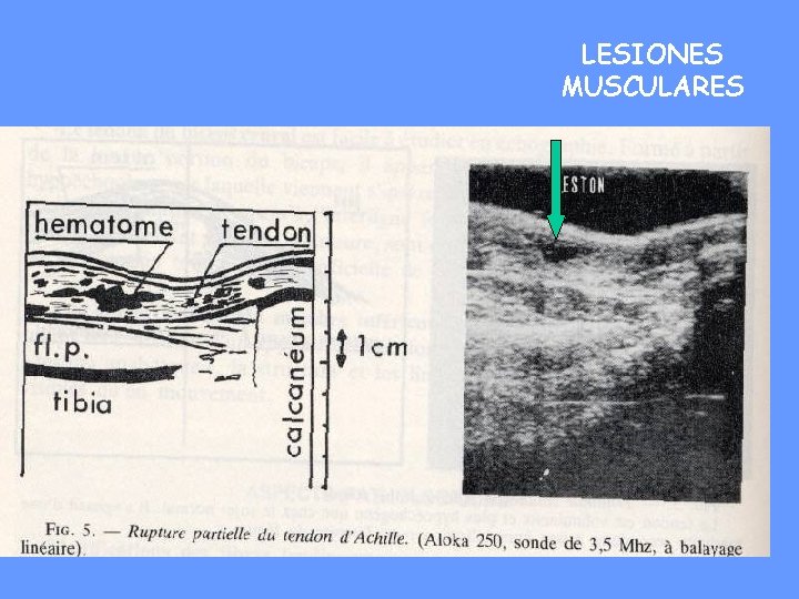 LESIONES MUSCULARES 